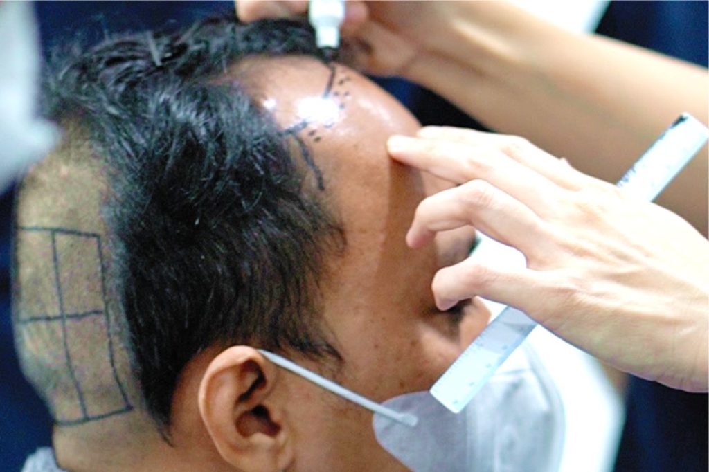 Graft Grading Transplantasi Rambut Terbaik
