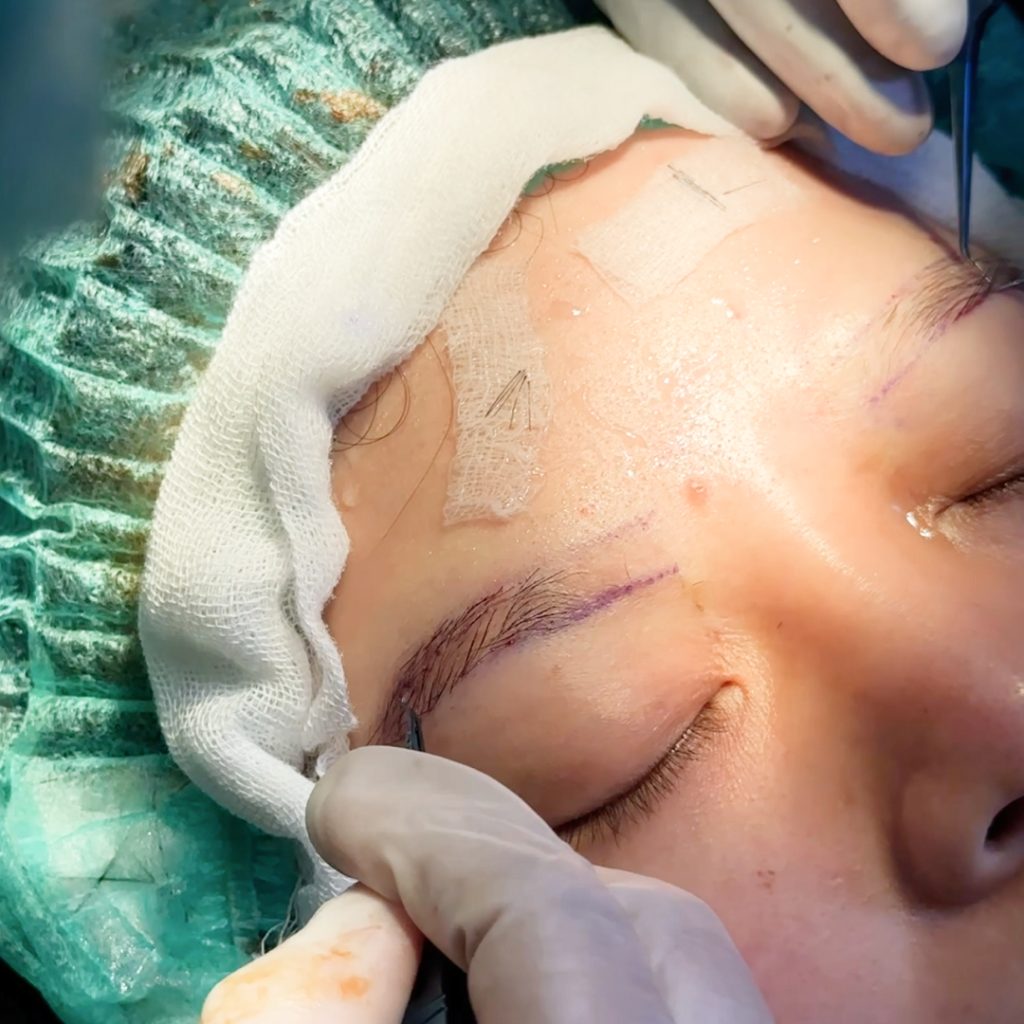 Program Eyebrow Transplant Tanam Alis Transplantasi Alis di Indonesia FUE DHI